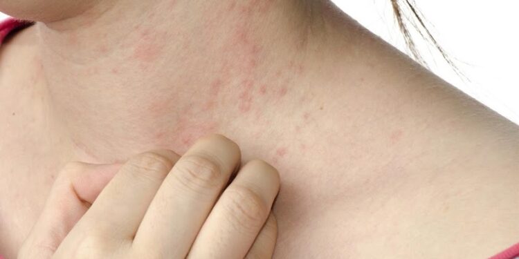 Dermatólogos alertan sobre manifestaciones cutáneas asociadas al coronavirus