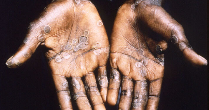 Reportan caso sospechoso de viruela del mono en Argentina