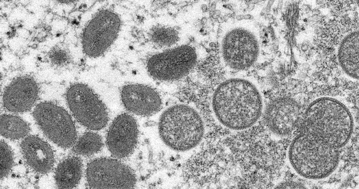 Se transmite por secreciones: síntomas y grupos de riesgo de viruela del mono ante primer caso confirmado en Chile