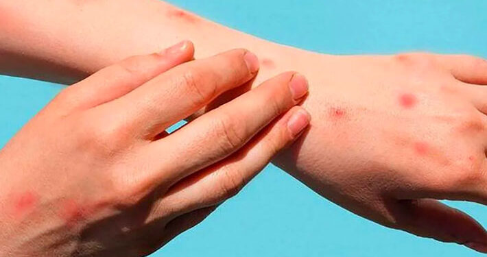 OMS informa que ya se han notificado más de 6.000 casos de viruela del mono en 58 países