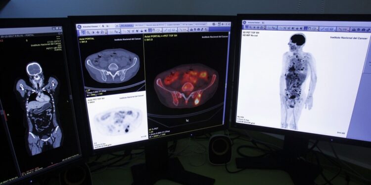 Día contra Cáncer de Colon: En Chile se ha triplicado en población joven