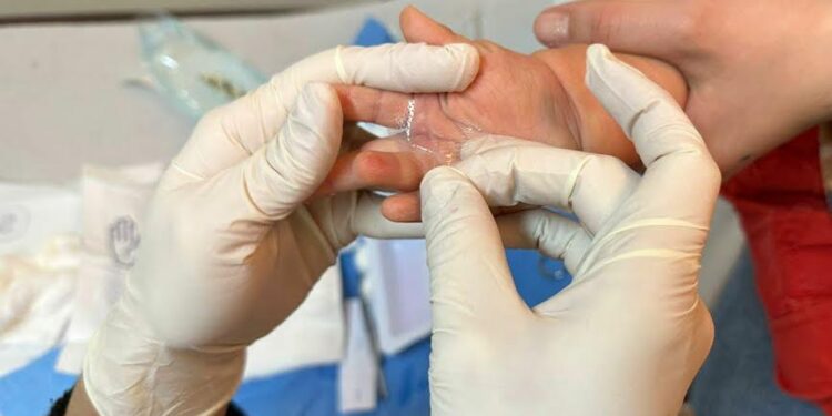 Hospital Osorno llama a prevenir quemaduras domésticas en niños