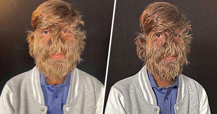 Joven indio de 18 años obtiene el récord Guinness por tener el rostro con más vello